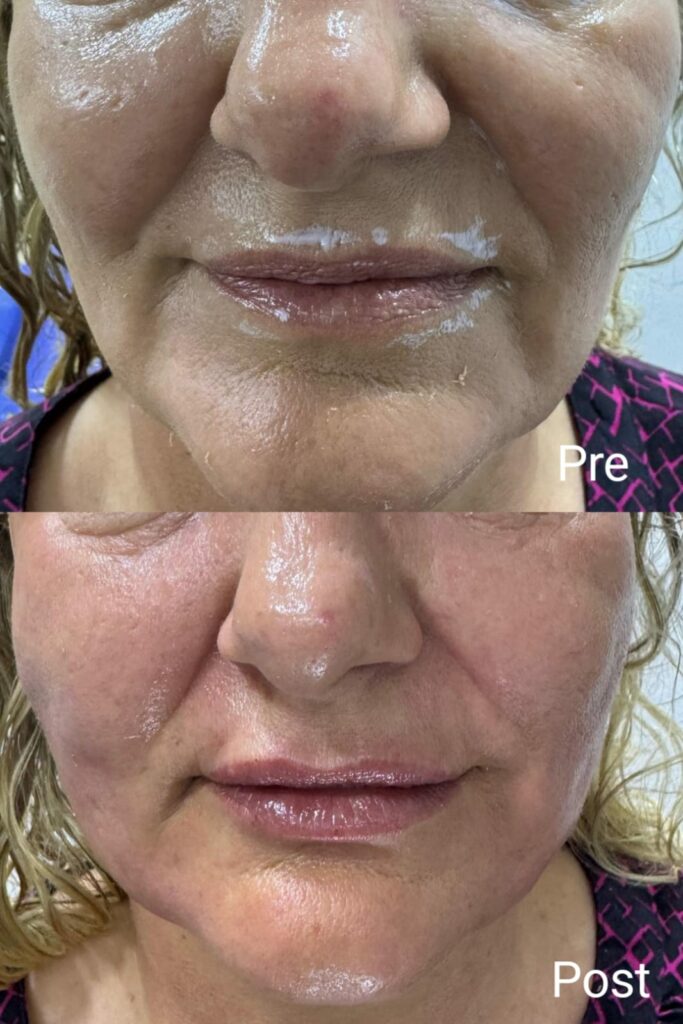 شد ورفع الخدود